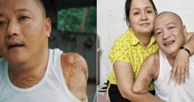 Mất 2 tay 1 chân sau tai nạn, người đàn ông tìm lại cuộc đời nhờ tình yêu của vợ