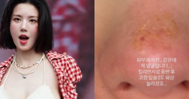 Nữ ca sĩ 31 tuổi bị bỏng nặng sau chuyến leo núi