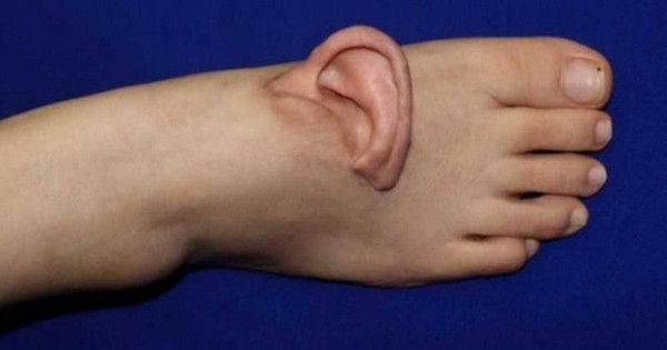 Nối lại tai đã đứt rời sau khi nuôi ở bàn chân suốt 5 tháng