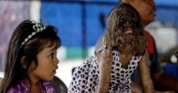 Cô bé “người sói” hiện ra sao?