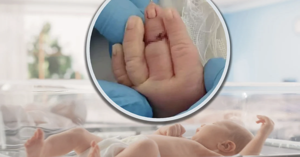 Cắt dây rốn, nữ hộ sinh vô tình cắt đứt ngón tay trẻ sơ sinh: Bé phải nối ngón, gia đình bàng hoàng