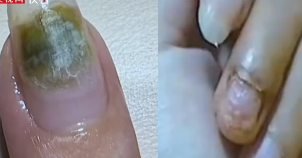 Trung Quốc: Tiệm nail khiến nhiều người nhiễm HPV do khử trùng dụng cụ làm móng qua loa