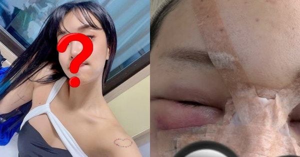 Trùng tu nhan sắc để ăn Tết, 1 sao nữ mặt mũi biến dạng, sưng phồng như bị 