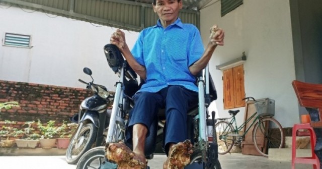 Cuộc sống của người đàn ông mắc bệnh 'người cây' hiếm gặp ở Ninh Bình