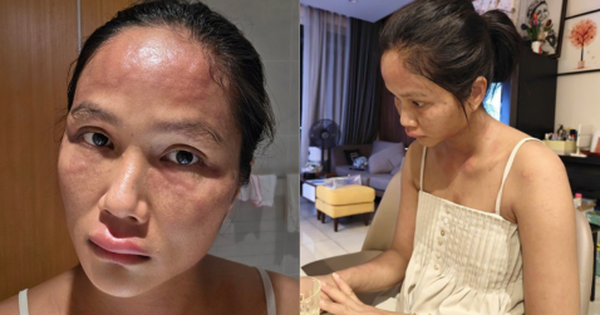 Gương mặt biến dạng sau sinh của H'Hen Niê