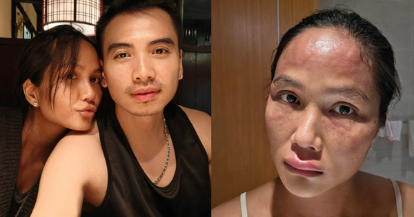 Hoa hậu H'Hen Niê sau khi bị biến dạng mặt