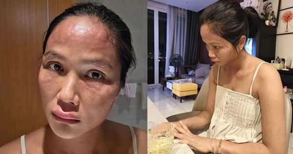 Chuyện gì xảy ra với H'Hen Niê sau khi xuất hiện với gương mặt khác lạ